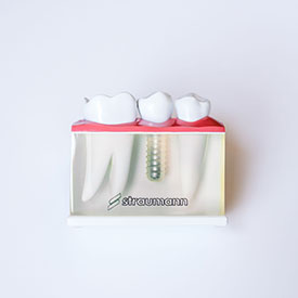 dental implants